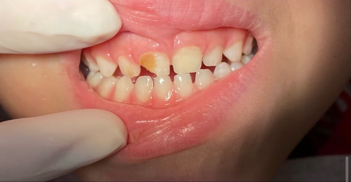 Dente de leite fraturado — antes